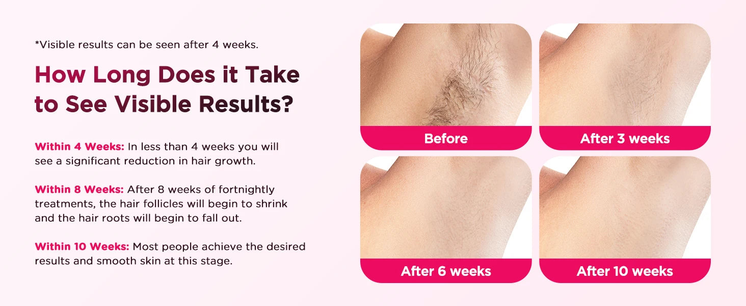IPL Laser Hair Removal Device - Permanent & Painless for Men & Women